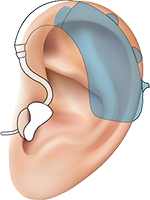 Аналоговые слуховые аппараты