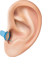 Глубококанальные слуховые аппараты