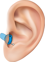 Внутриканальные слуховые аппараты